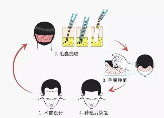 毛囊克隆技术最新进展与步骤指南